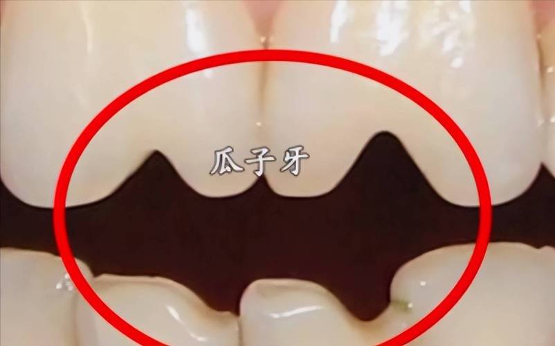 门牙上的“豁口”真是嗑瓜子惹的祸?多年来的困惑终于解开了!